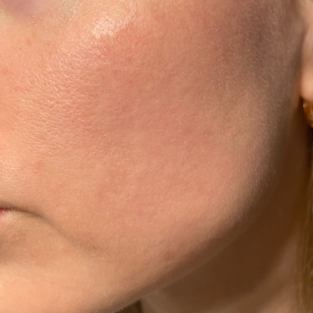 Dermure - Treatment 1 After