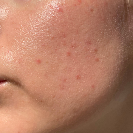 Dermure - Treatment 1 Before